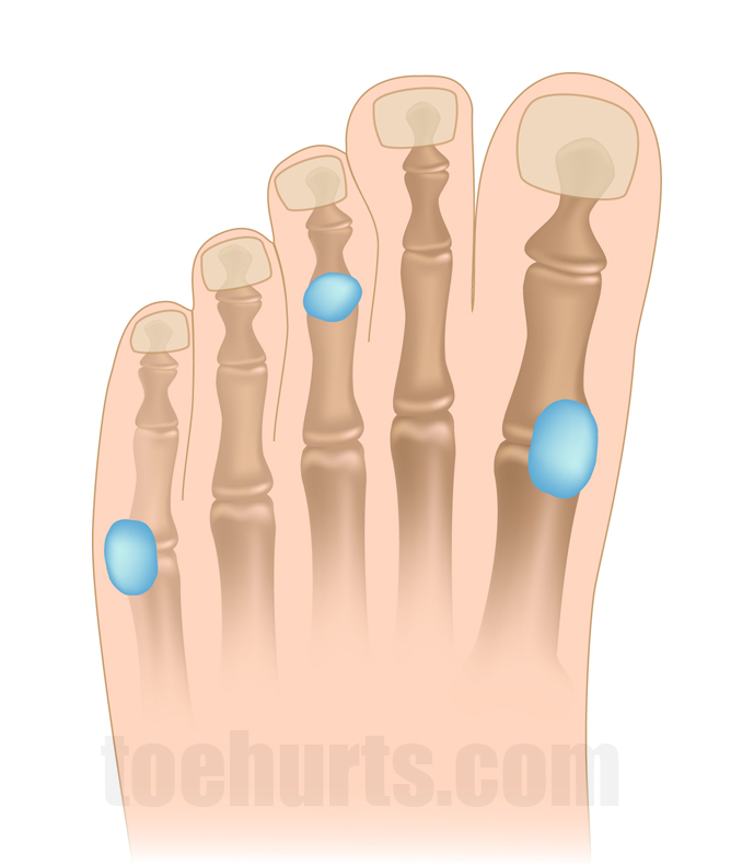 You are currently viewing Toe Bursitis Causes, Symptoms, Treatment and Self-Help