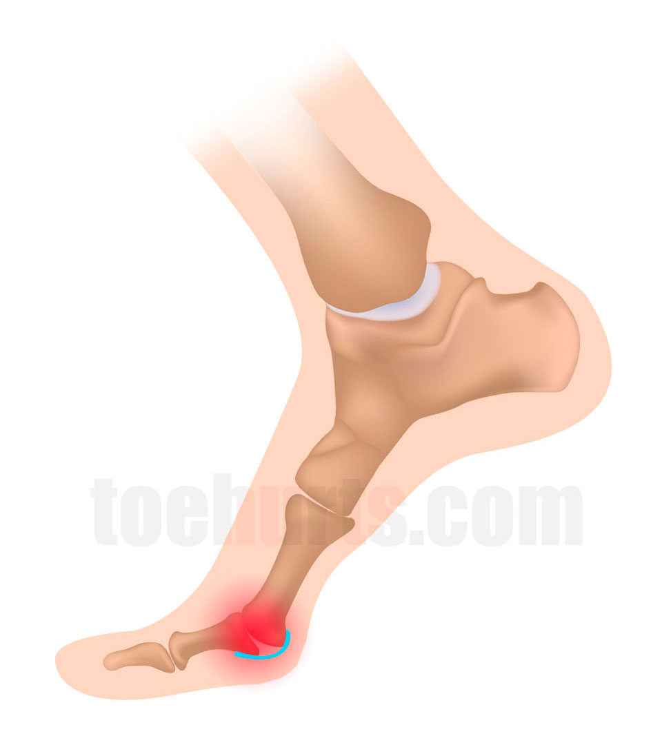 You are currently viewing Sprained Toe Causes, Symptoms, Treatment and Self-Help