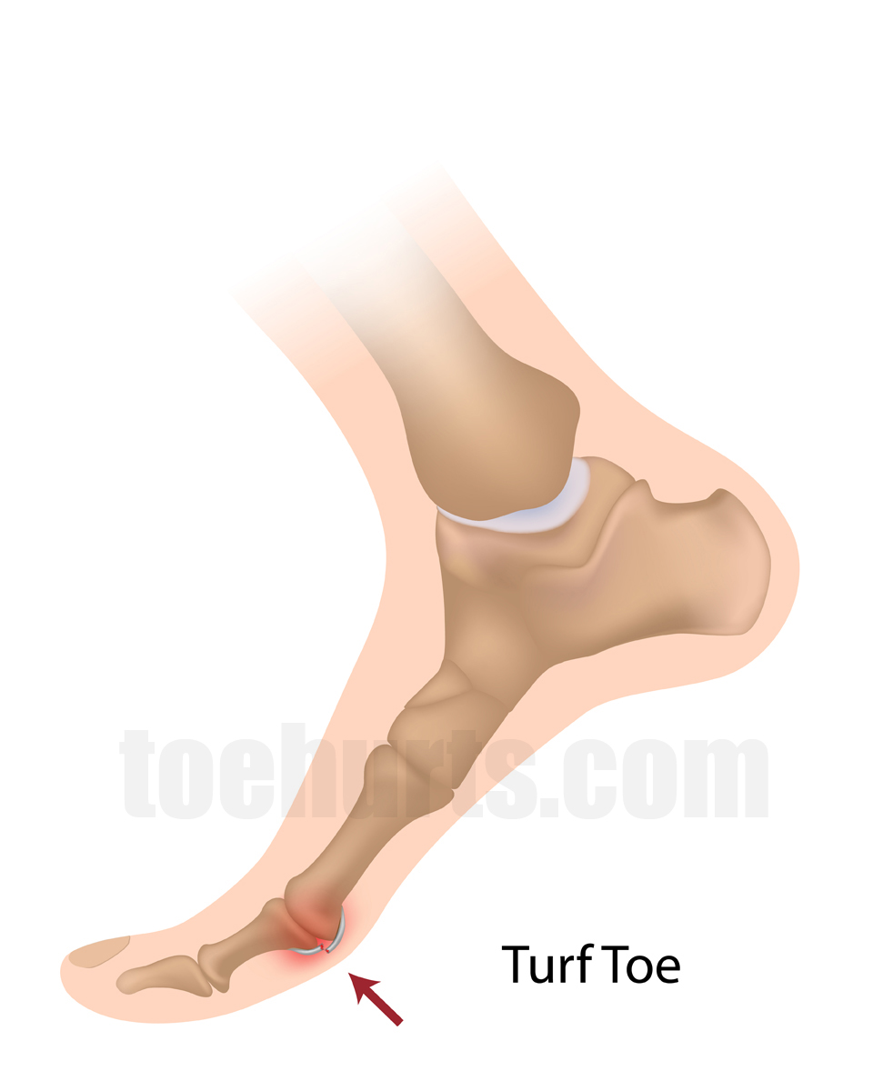 Read more about the article Turf Toe Causes, Symptoms and Treatment